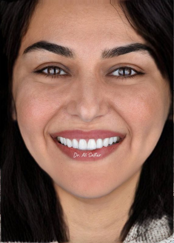 بهترین دکتر ایمپلنت در زعفرانیه